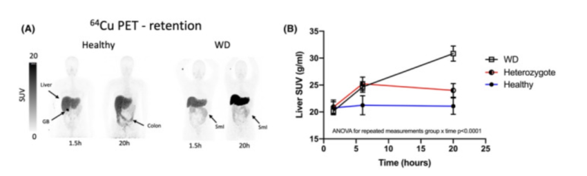 Wilson’s disease: ATP7B gene mutations and copper in the brain